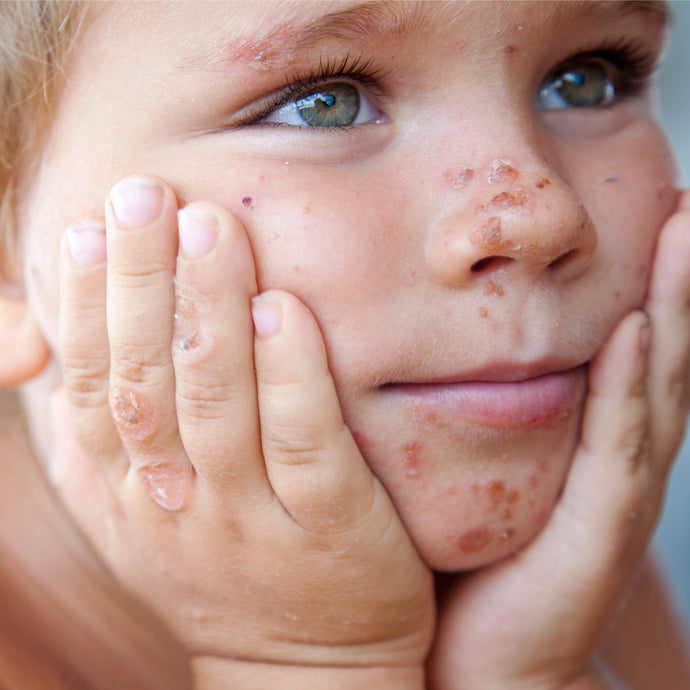 How to Help Your Child Get Through Psoriasis