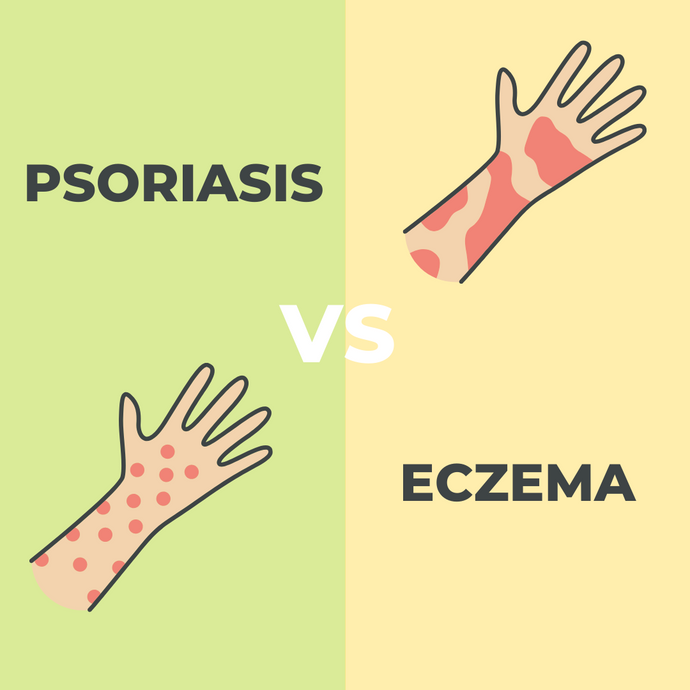 Psoriasis vs Eczema - What's the Difference Between Them